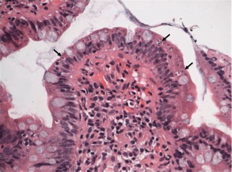 Histology of terminal ileum showing villus blunting and the presence of ...