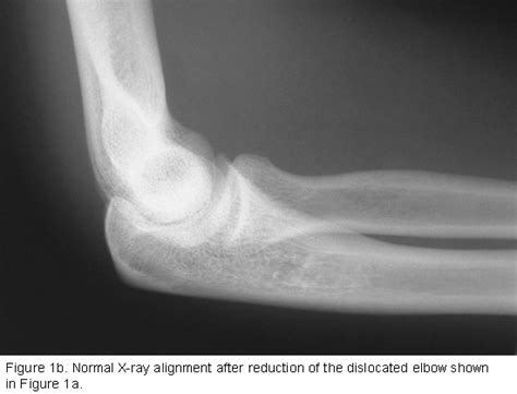 Dislocated Elbow - Orthopedic Specialists of Seattle