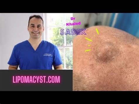 Massive Pilar cyst removal : r/Popping_Curated