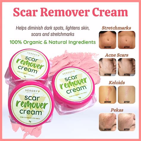 Keloid & Stretch mark Remover Cream Scar Remover Cream MIRACLE CREAM ...