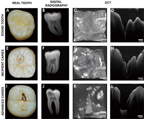 Photoacoustic imaging of occlusal incipient caries in the visible and near-infrared range