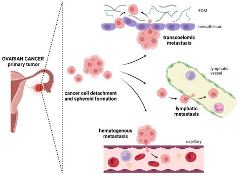 Cancers | Free Full-Text | A Recipe for Successful Metastasis ...