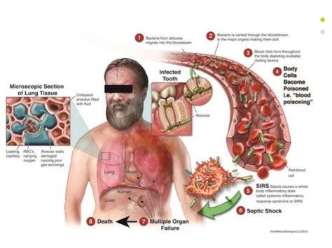 mrsa pictures symptoms - pictures, photos