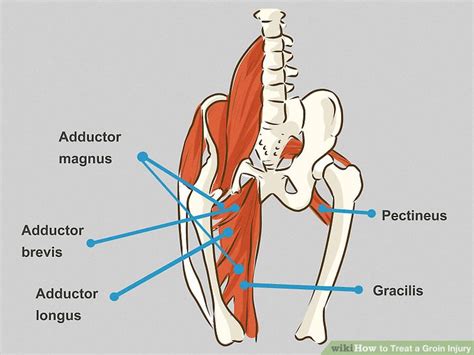 How to Treat a Groin Injury (with Pictures)