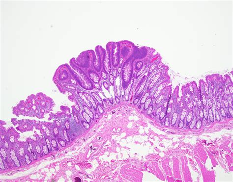 Case of the Month: Numerous Colonic Polyps - University of Rochester ...