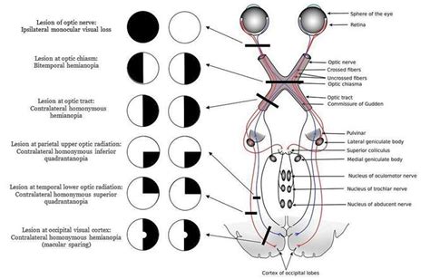 Visual field lesions - MEDizzy