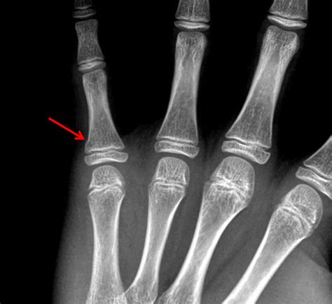 Salter Harris Type 2 Fracture Finger