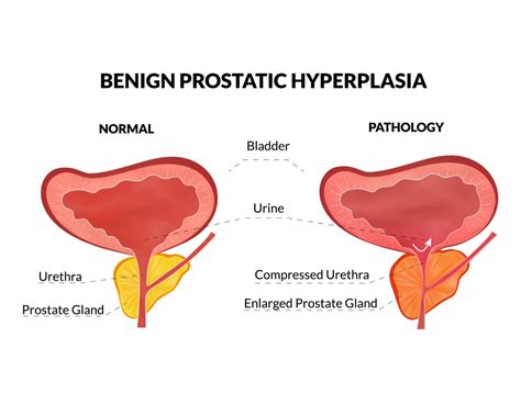 Early Signs of Benign Prostatic Enlargement - Enlarged Prostate ...