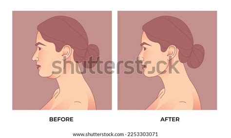 Double Chin Liposuction Before After Brachioplasty Stock Vector (Royalty Free) 2253303071 ...