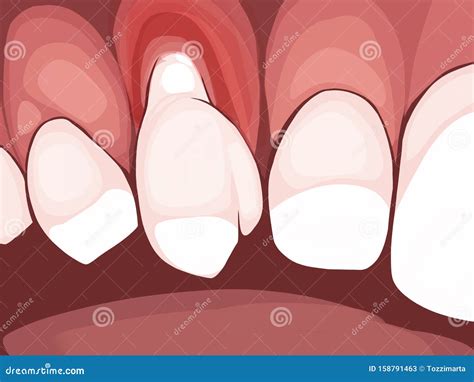 Necrotizing Ulcerative Gingivitis is a Periodontal Diseases Stock Illustration - Illustration of ...