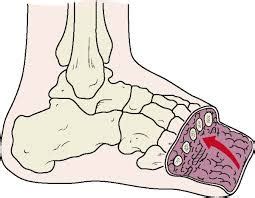 Transmetatarsal amputation Pictures, Rehabilitation, Recovery, Prosthesis - Health Care Tips and ...