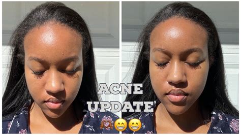 Perioral Dermatitis and Hormonal Acne Update! 9 months using Dapsone Gel and Tretinoin + Acne ...