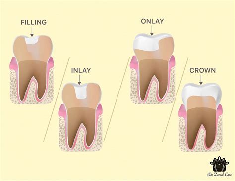 Fillings VS Inlay/Onlay VS Crown - Elite Dental Care Tracy | Elite ...