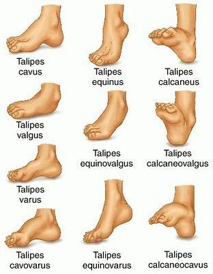 Talipes-congenital deformity of the foot, usually marked by a curled ...