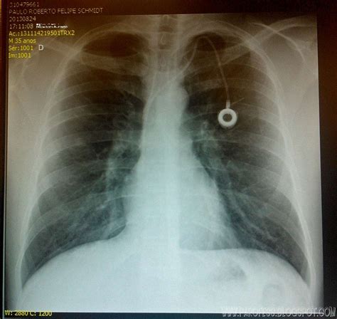 Super cool X ray view of Parofes' Port a Cath! : Photos, Diagrams & Topos : SummitPost