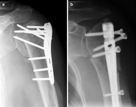 4 Proximal humeral fracture complications subsequent to osteosynthesis ...