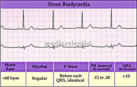 Sinus Tachycardia and Sinus Bradycardia Definition Causes and Treatment ...