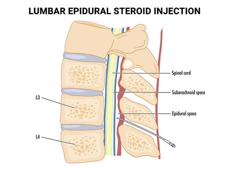 Lumbar Epidural Steroid Injections | Epidural for Back Pain in NJ & NYC