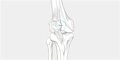 Patellar Dislocation - The Complete Injury Guide - Vive Health