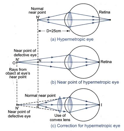 What is hypermetropia? Write two causes for development of this defect - CBSE Class 10 Science ...