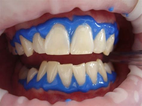 Is It Safe To Use Baking Soda & Hydrogen Peroxide To Whiten Teeth? | Build-A-Smile