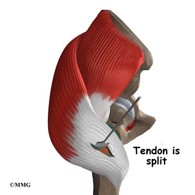 Trochanteric Bursitis Surgery | eOrthopod.com