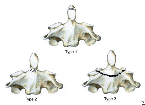 Type 2 odontoid fracture x ray - jokercalifornia