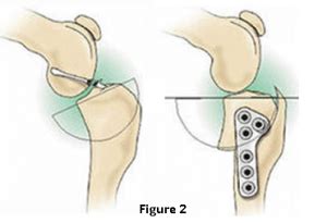 Tibial Plateau Levelling Osteotomy (TPLO) - Melbourne Bulldog Clinic