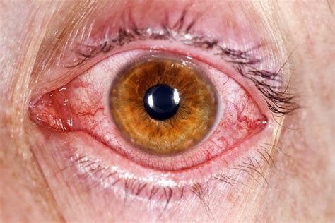 Conjunctivitis - DugaldArgyrios