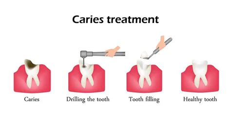 How Dentists Treat Tooth Decay? | Simply Dental Chatswood