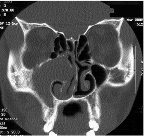 Coronal CT scan, bone windows, soft tissue mass obstructing the right... | Download Scientific ...