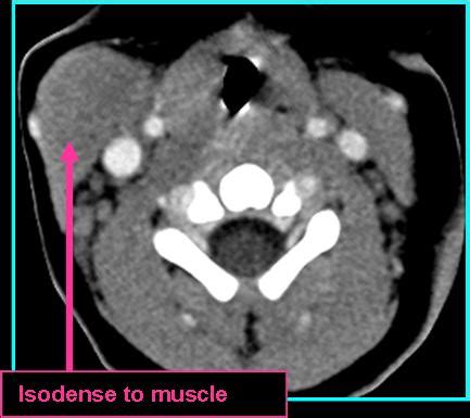 Fibromatosis Colli Rads | Iowa Head and Neck Protocols