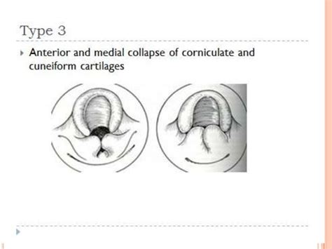 Laryngomalacia BY ZAINAB AHMED