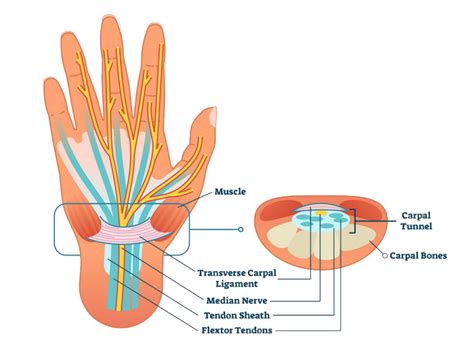 Carpal tunnel syndrome | Medical Tourism Italy