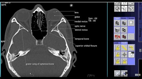 how to read ct scan PNS axial view With Text - YouTube