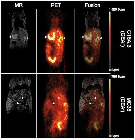 MRI and PET scan results for liver metastases originating from C15A.3 ...