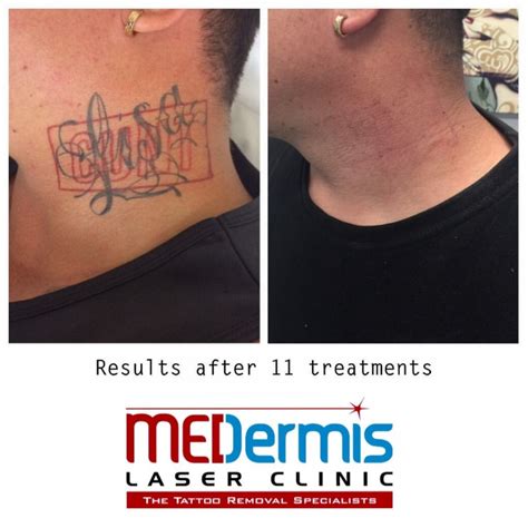 Laser Tattoo Removal No Results