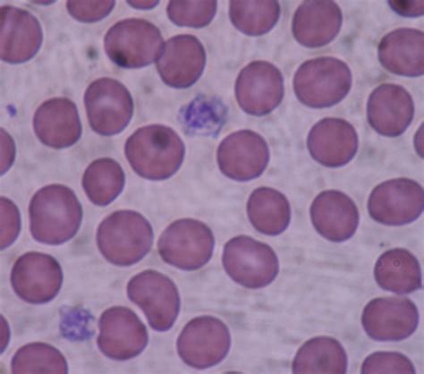 File:Giant platelets.JPG - Wikimedia Commons