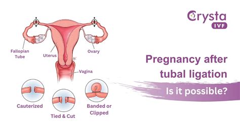 Can Pregnancy Occur After Tubal Ligation?