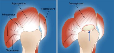 Rotator Cuff Tears - OrthoInfo - AAOS