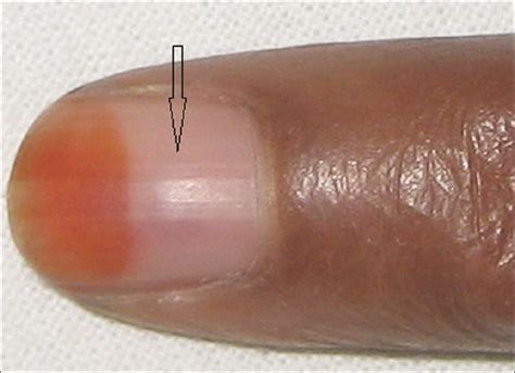 Nail avulsion: Indications and methods (surgical nail avulsion) - Indian Journal of Dermatology ...