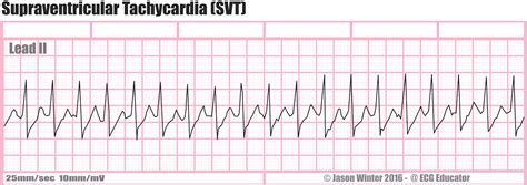 ECG Educator Blog : Six Second ECG Rhythm Strips