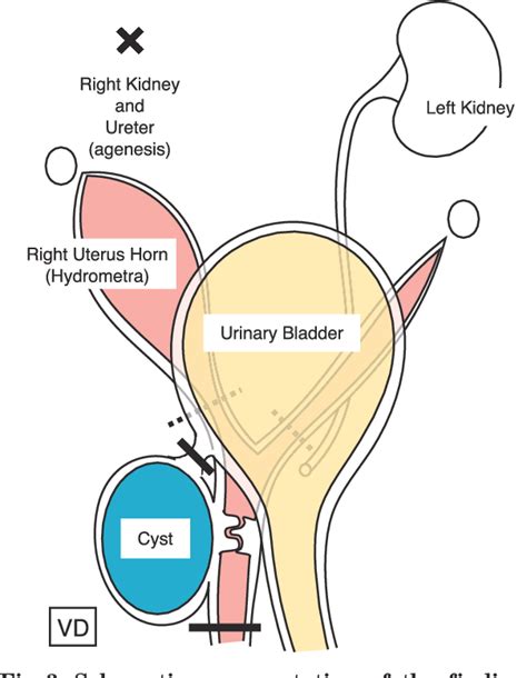 Gartner Duct Cyst Anatomy