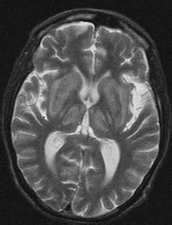 Hypoxic Brain Injury-MRI - Sumer's Radiology Blog