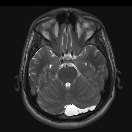 Intracranial epidermoid cyst | Radiology Reference Article | Radiopaedia.org