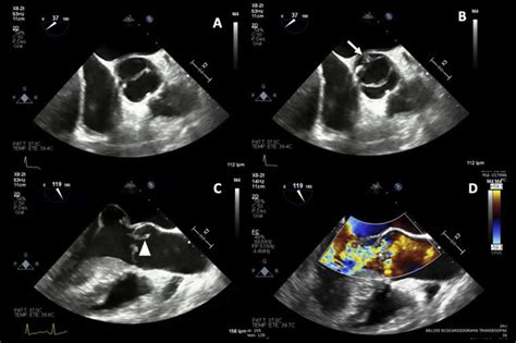 TEE. (A, B) Aortic valve short-axis view: bicuspid aortic valve with ...