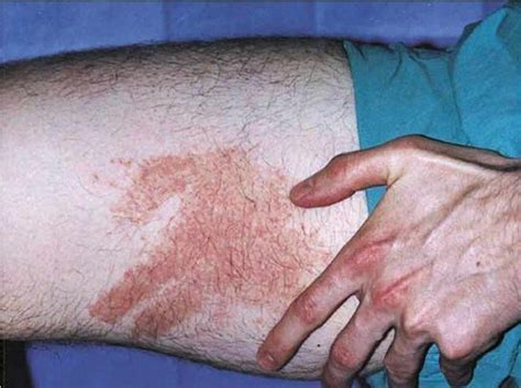 Delayed pressure urticaria causes, symptoms, diagnosis & treatment