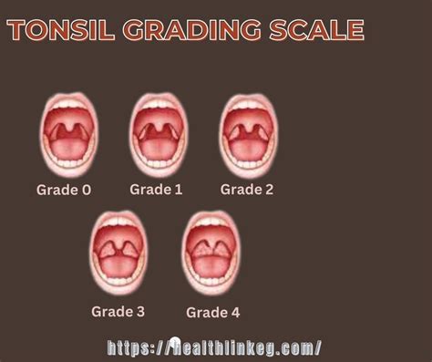 The Big Value From Using Tonsil Grading Scale | The Scale In 2024 ...