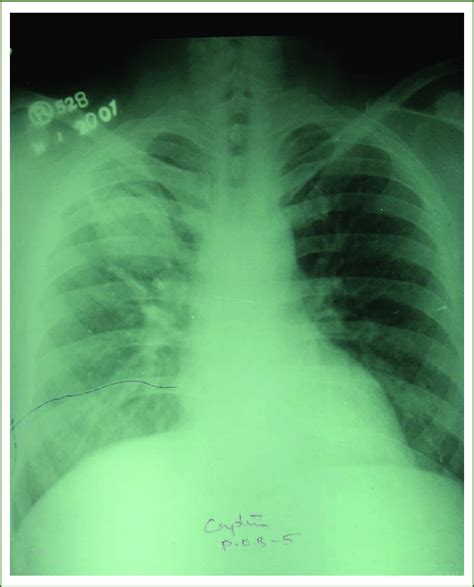 X-ray chest of a patient of aspergilloma in right upper lobe. | Download Scientific Diagram