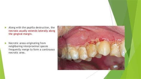 Necrotizing periodontal disease